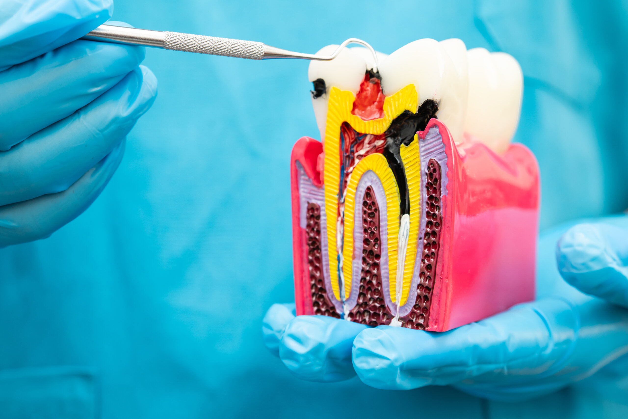 Root canal therapy at ETON Dental in Canoga Park, Los Angeles, CA – saving infected teeth, relieving pain, and restoring natural tooth function.