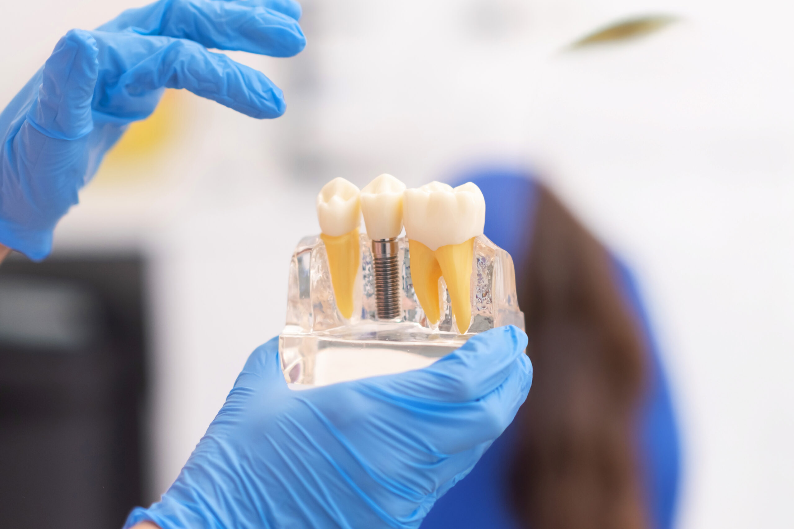 Dental implants procedure at ETON Dental in Canoga Park, Los Angeles, CA – permanent solution for missing teeth restoring natural smile and function.